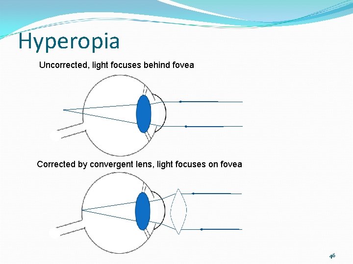 Hyperopia Uncorrected, light focuses behind fovea Corrected by convergent lens, light focuses on fovea