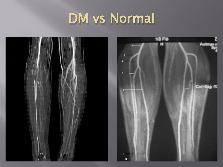 DM vs Normal 