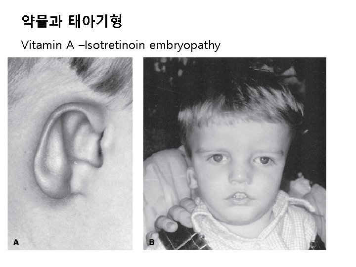 약물과 태아기형 Vitamin A –Isotretinoin embryopathy 