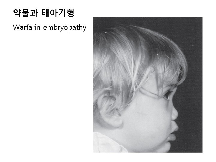 약물과 태아기형 Warfarin embryopathy 