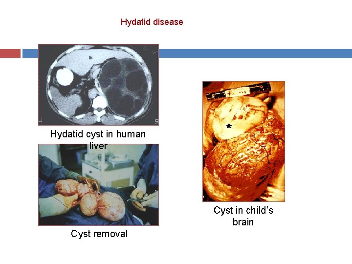 Hydatid disease Hydatid cyst in human liver Cyst in child’s brain Cyst removal 