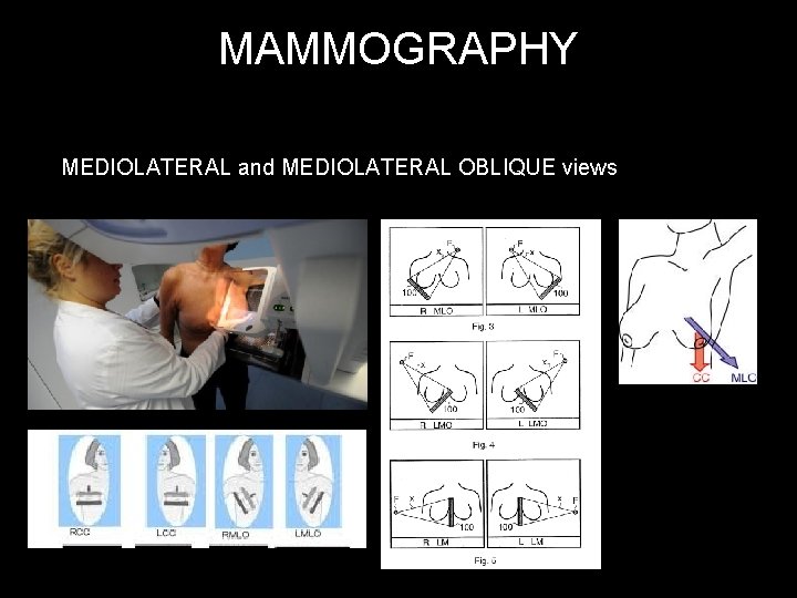 MAMMOGRAPHY MEDIOLATERAL and MEDIOLATERAL OBLIQUE views 
