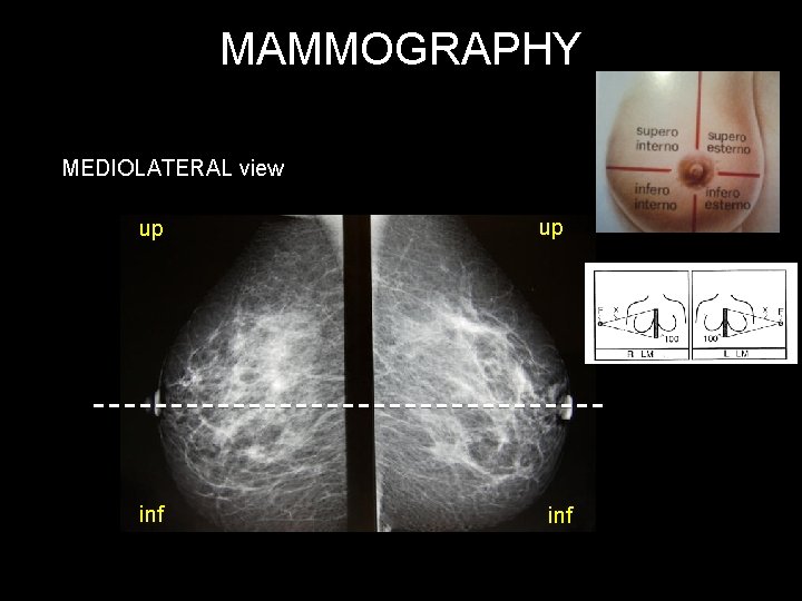 MAMMOGRAPHY MEDIOLATERAL view up inf 