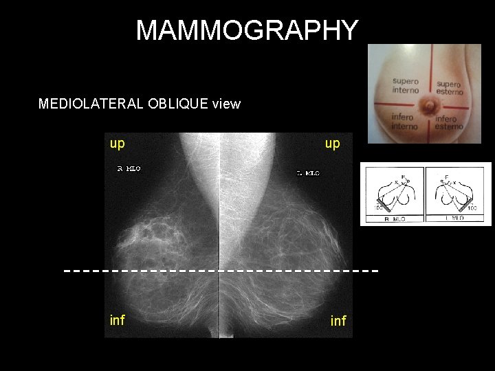 MAMMOGRAPHY MEDIOLATERAL OBLIQUE view up inf 
