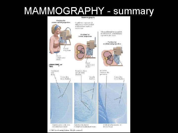 MAMMOGRAPHY - summary 