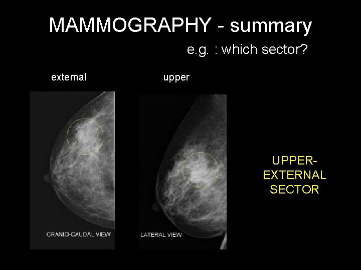 MAMMOGRAPHY - summary e. g. : which sector? external upper UPPEREXTERNAL SECTOR 