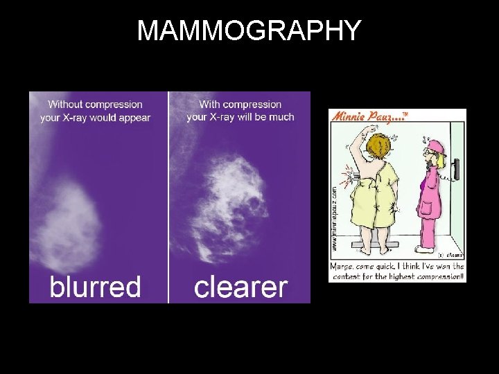 MAMMOGRAPHY 