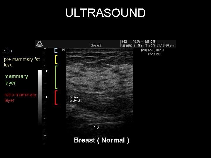 ULTRASOUND skin pre-mammary fat layer mammary layer retro-mammary layer muscle pectoralis rib 
