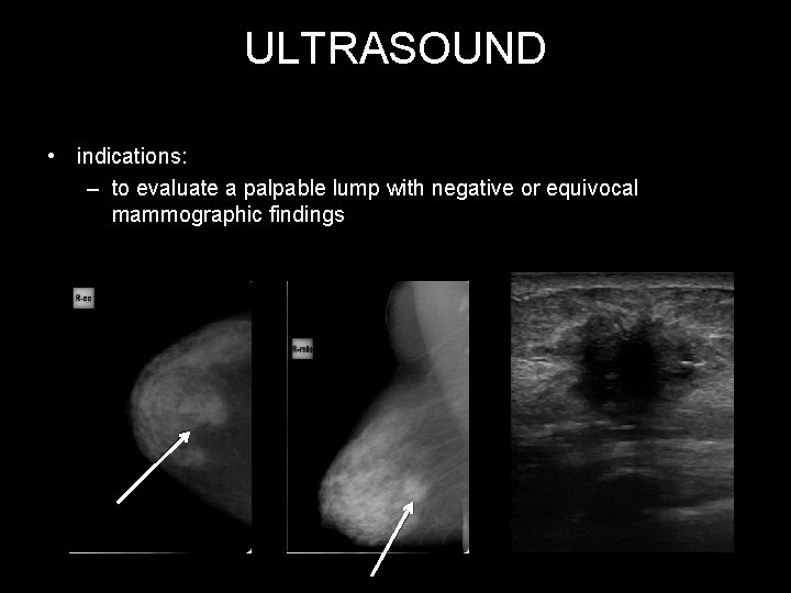 ULTRASOUND • indications: – to evaluate a palpable lump with negative or equivocal mammographic