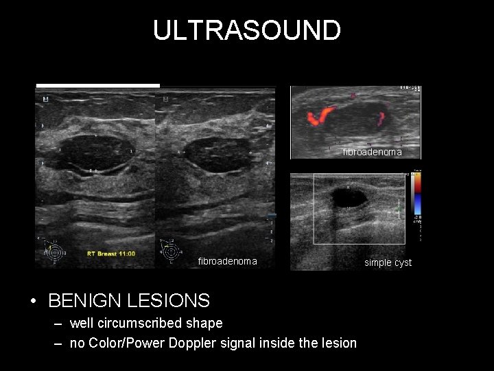 ULTRASOUND fibroadenoma • BENIGN LESIONS – well circumscribed shape – no Color/Power Doppler signal