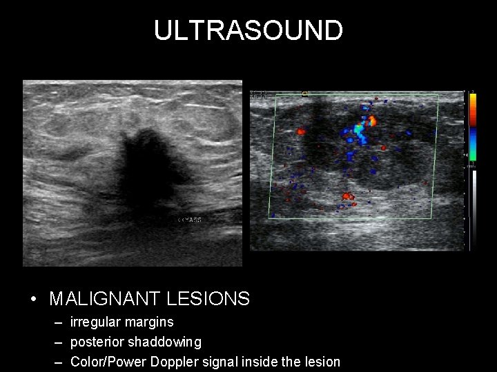 ULTRASOUND • MALIGNANT LESIONS – irregular margins – posterior shaddowing – Color/Power Doppler signal