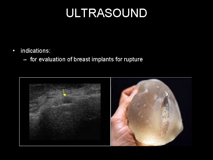 ULTRASOUND • indications: – for evaluation of breast implants for rupture 