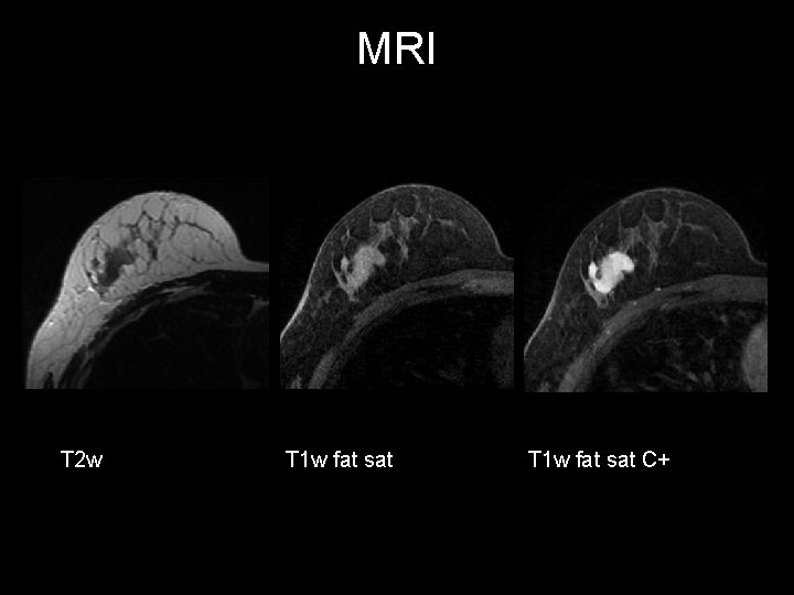 MRI T 2 w T 1 w fat sat C+ 