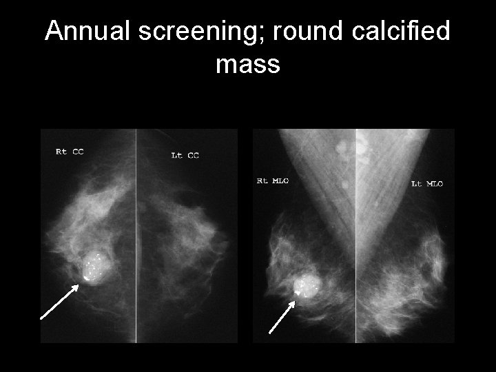 Annual screening; round calcified mass 
