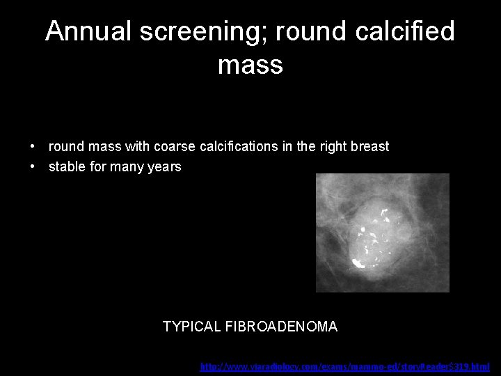 Annual screening; round calcified mass • round mass with coarse calcifications in the right