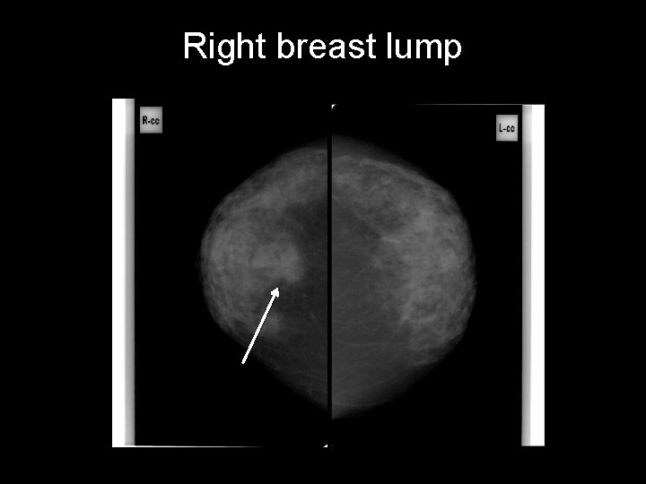 Right breast lump 