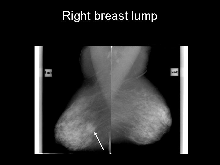 Right breast lump 