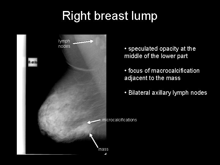Right breast lump lymph nodes • speculated opacity at the middle of the lower