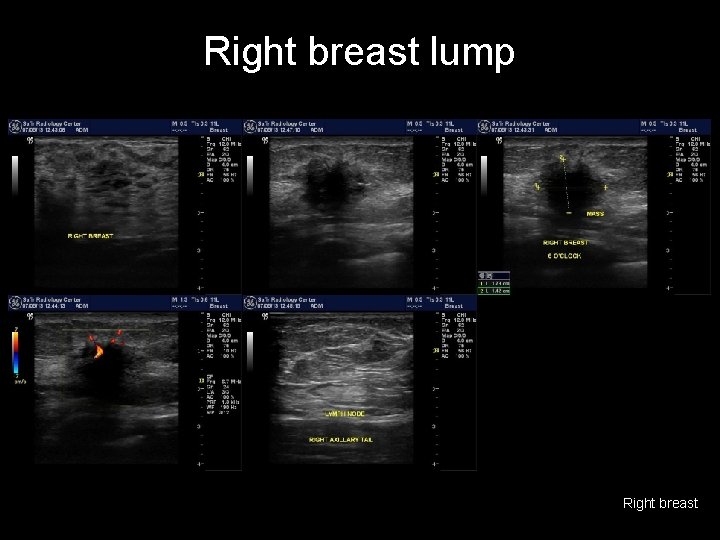 Right breast lump Right breast 