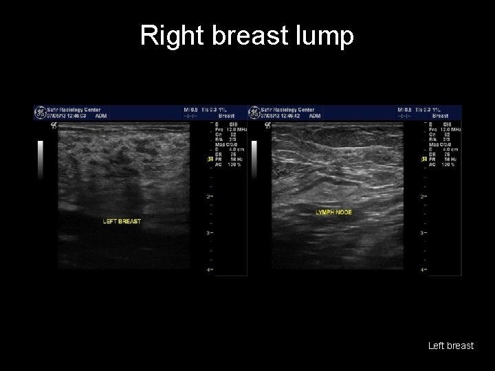 Right breast lump Left breast 