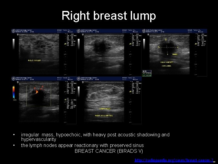 Right breast lump • • irregular mass, hypoechoic, with heavy post acoustic shadowing and
