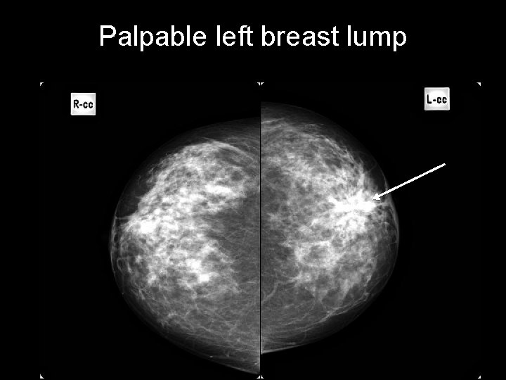 Palpable left breast lump 