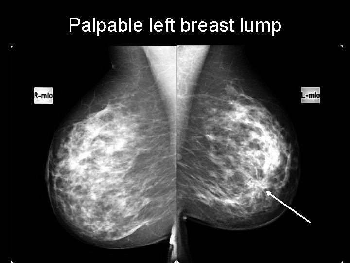 Palpable left breast lump 
