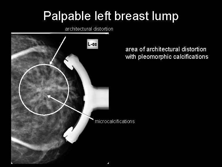 Palpable left breast lump architectural distortion area of architectural distortion with pleomorphic calcifications microcalcifications