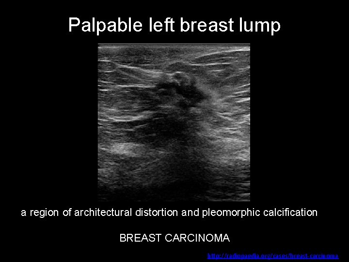 Palpable left breast lump a region of architectural distortion and pleomorphic calcification BREAST CARCINOMA