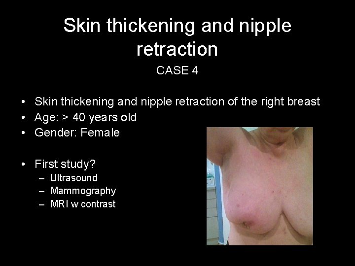 Skin thickening and nipple retraction CASE 4 • Skin thickening and nipple retraction of