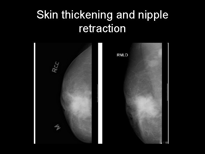 Skin thickening and nipple retraction 