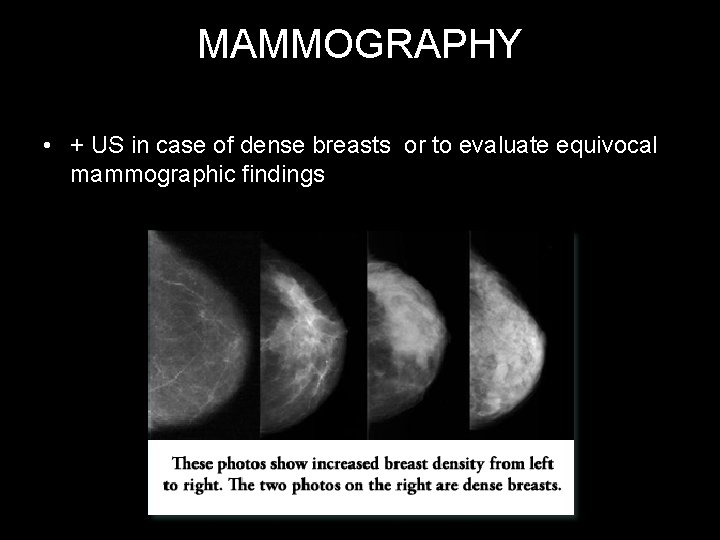 MAMMOGRAPHY • + US in case of dense breasts or to evaluate equivocal mammographic