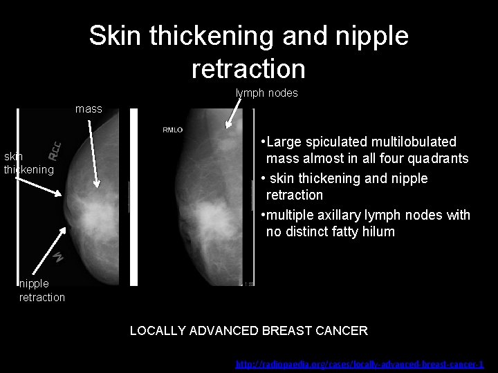Skin thickening and nipple retraction lymph nodes mass skin thickening • Large spiculated multilobulated