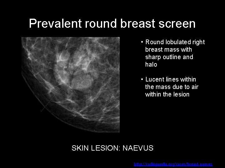 Prevalent round breast screen • Round lobulated right breast mass with sharp outline and