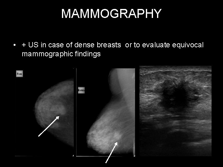 MAMMOGRAPHY • + US in case of dense breasts or to evaluate equivocal mammographic
