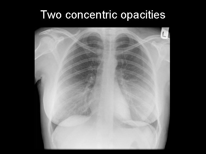Two concentric opacities 