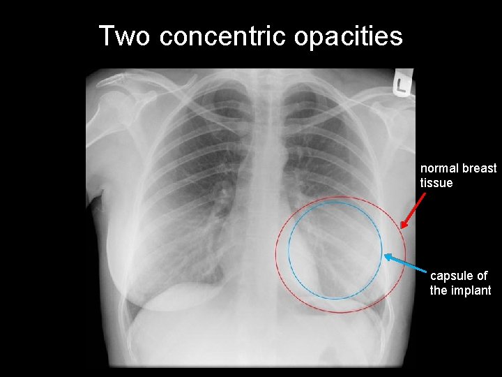 Two concentric opacities normal breast tissue capsule of the implant 