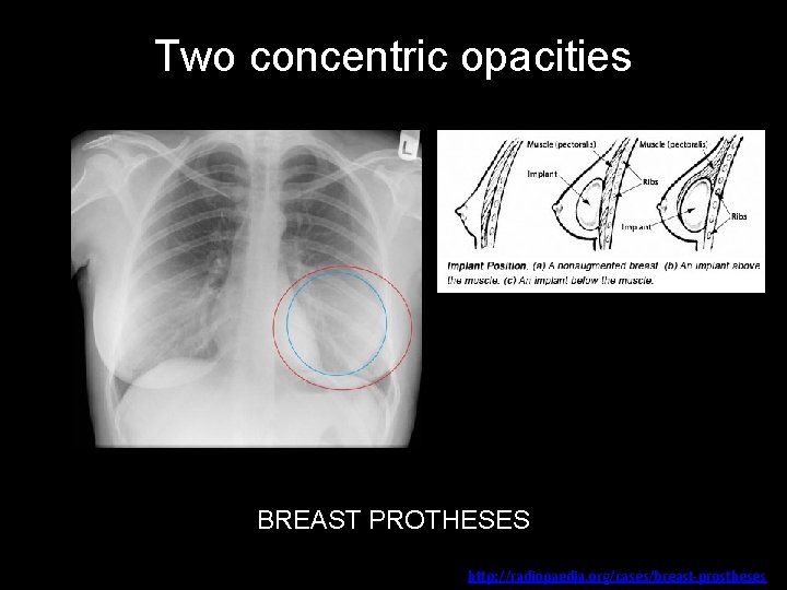 Two concentric opacities BREAST PROTHESES http: //radiopaedia. org/cases/breast-prostheses 