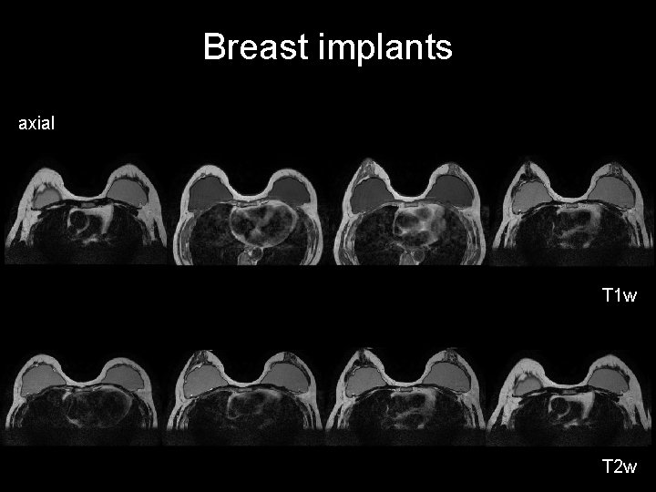 Breast implants axial T 1 w T 2 w 