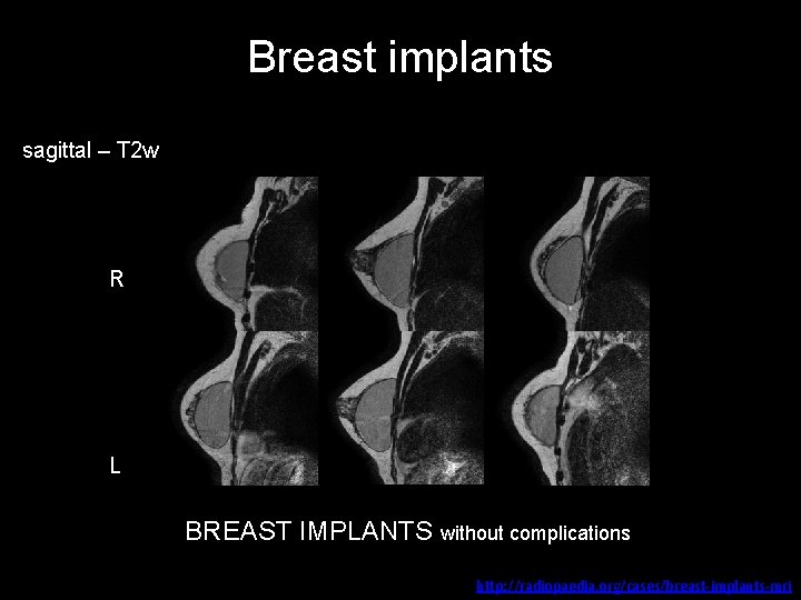 Breast implants sagittal – T 2 w R L BREAST IMPLANTS without complications http: