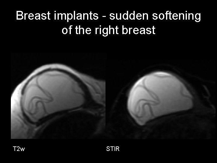 Breast implants - sudden softening of the right breast T 2 w STIR 