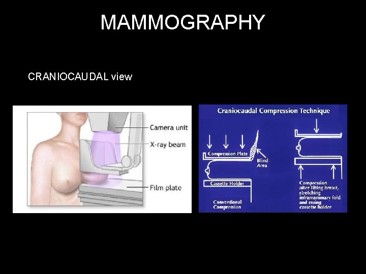 MAMMOGRAPHY CRANIOCAUDAL view 