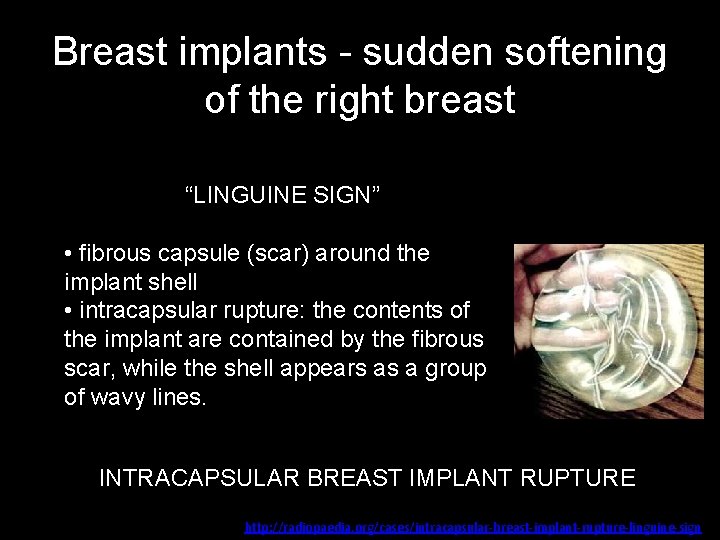 Breast implants - sudden softening of the right breast “LINGUINE SIGN” • fibrous capsule