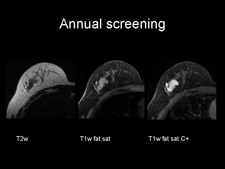 Annual screening T 2 w T 1 w fat sat C+ 
