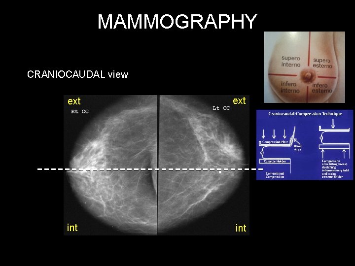 MAMMOGRAPHY CRANIOCAUDAL view ext int 