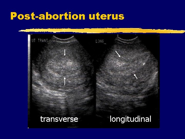 Post-abortion uterus transverse longitudinal 