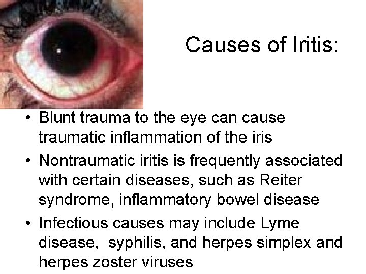 Causes of Iritis: • Blunt trauma to the eye can cause traumatic inflammation of