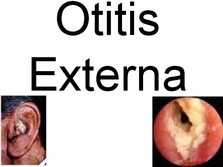 Otitis Externa 