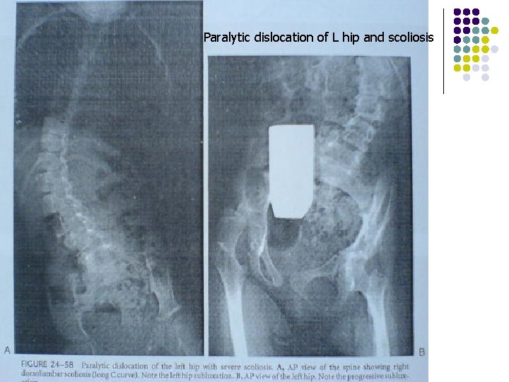 Paralytic dislocation of L hip and scoliosis 