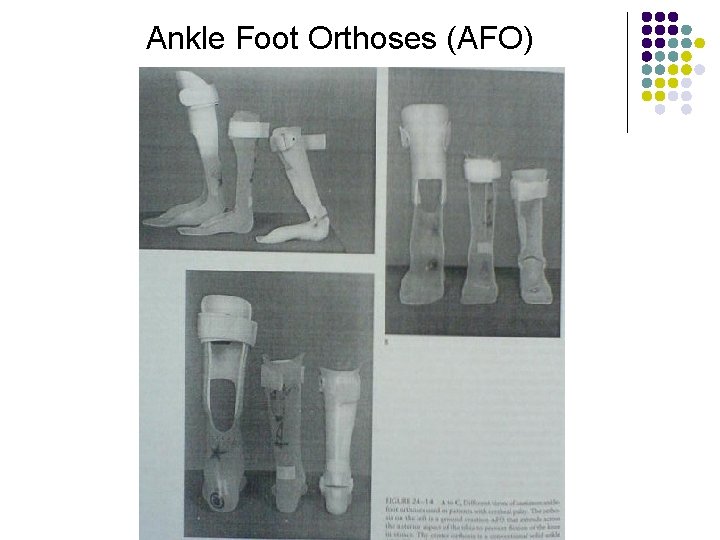 Ankle Foot Orthoses (AFO) 